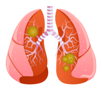 Профилактика пневмонии